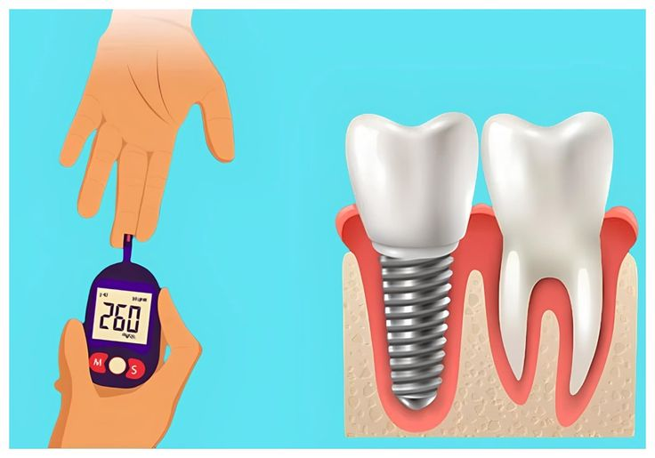 Tiểu đường có trồng răng Implant được không?