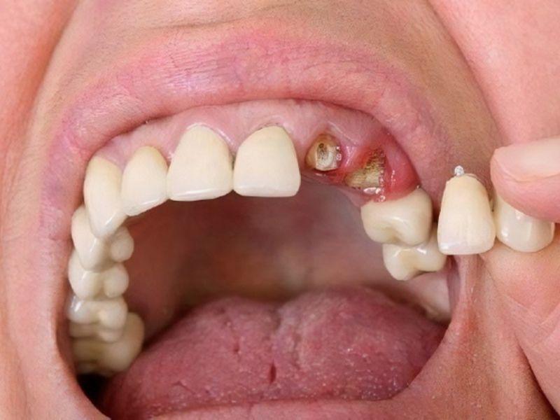 A broken tooth cannot grow back on its own, but there are effective restoration methods