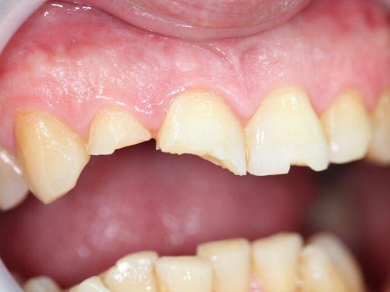 Silent factors causing teeth to break, leaving only the root