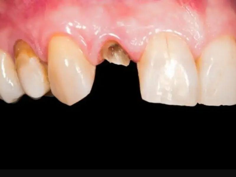 Treating a broken tooth early helps prevent infection and keeps your smile confident