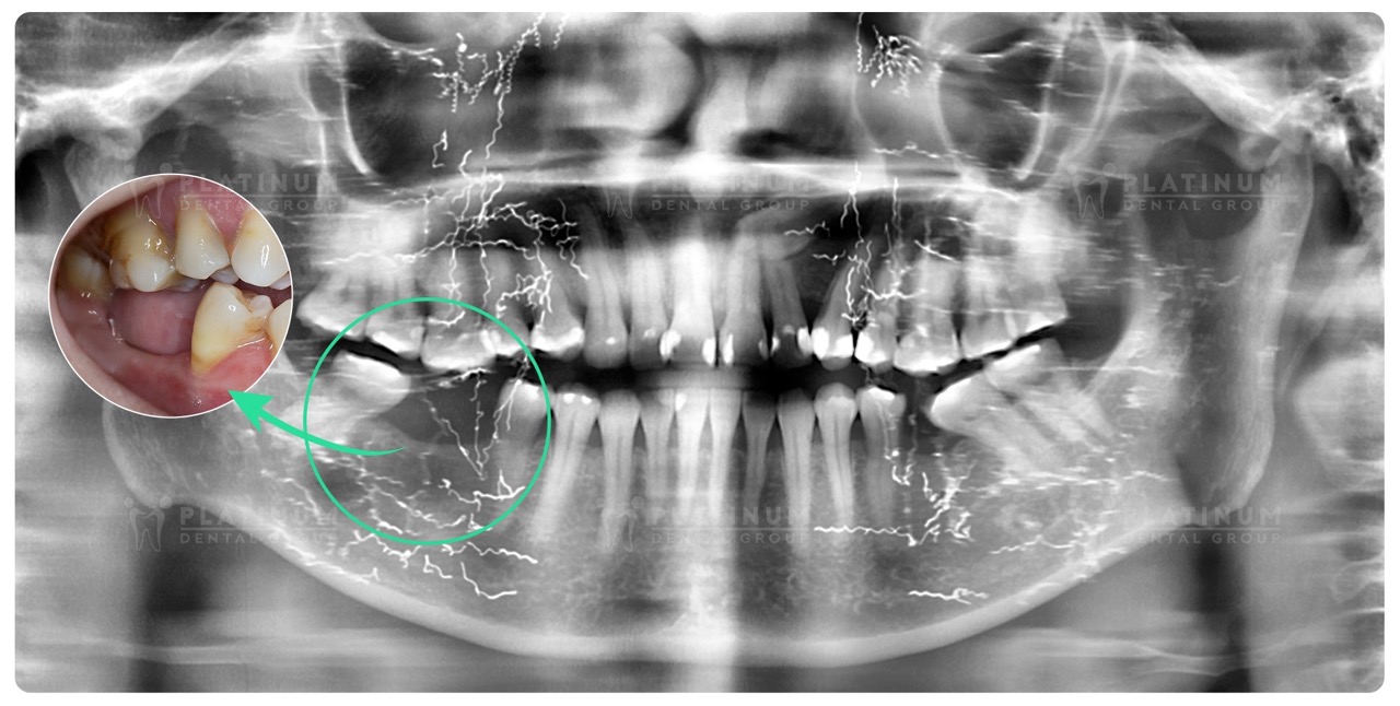MIDU VÀ HÀNH TRÌNH TRỒNG RĂNG IMPLANT CHO MẸ 1 Tình trạng mất răng của cô Hà được ghi nhận qua hình ảnh phim chụp x-quang