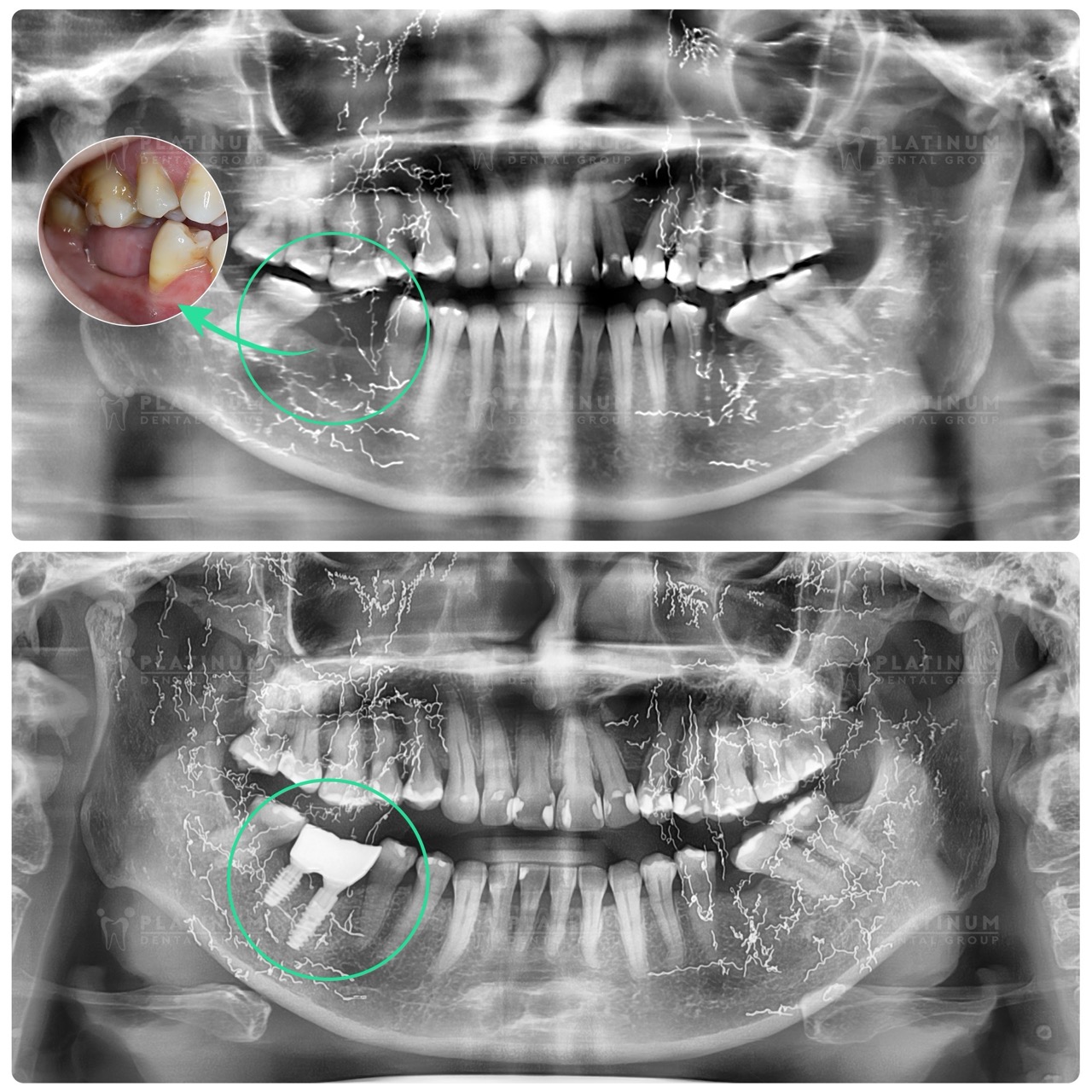 MIDU VÀ HÀNH TRÌNH TRỒNG RĂNG IMPLANT CHO MẸ 3 trong rang implant co thu ha4 Large