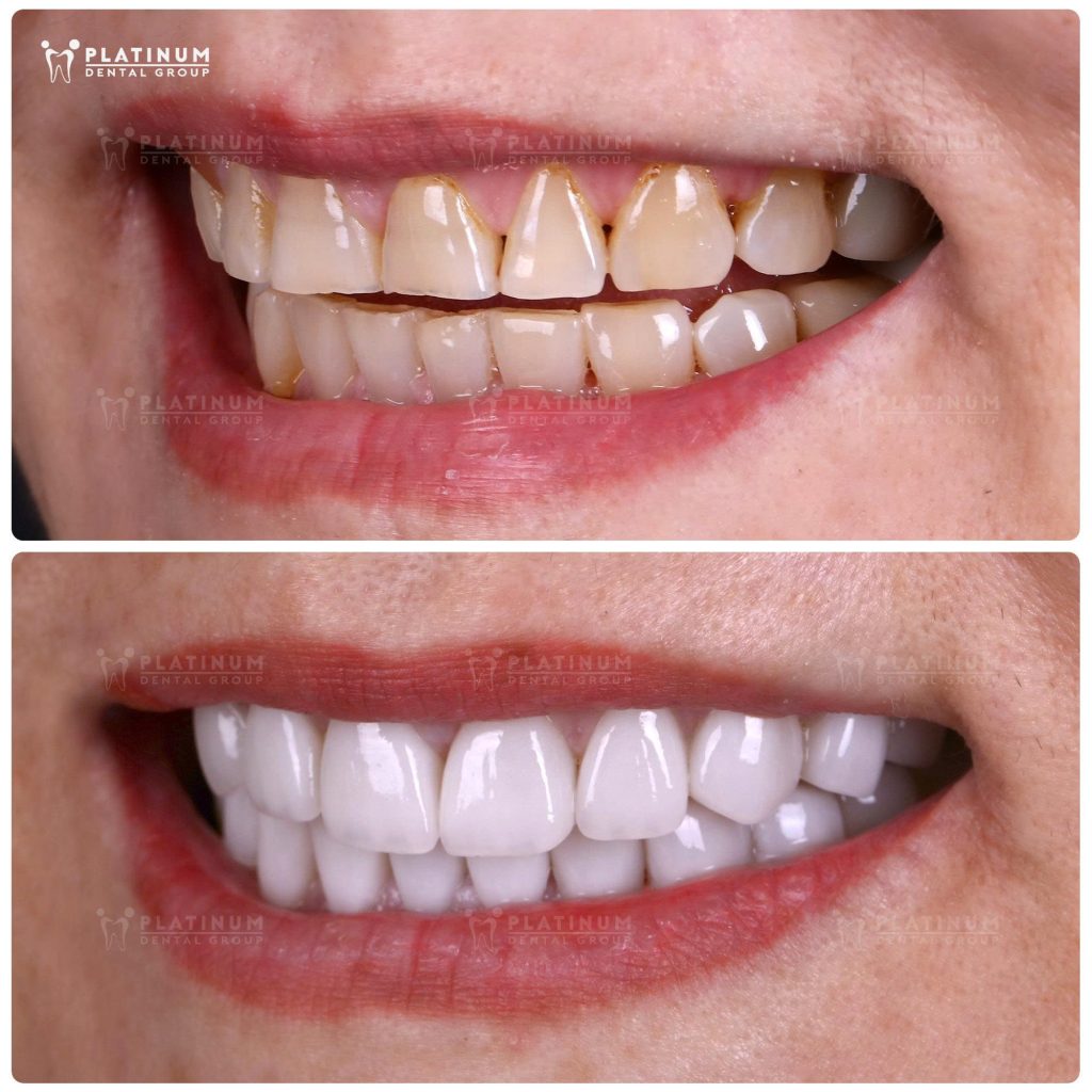 PLATINUM DENTAL ƯU ĐÃI CHỐT NĂM RẠNG RỠ NỤ CƯỜI 6 Kết quả dán sứ Veneer khắc phục răng mòn ngắn và xỉn màu cho chị khách U55