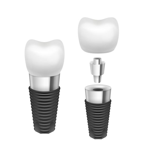 Dental Implant 2