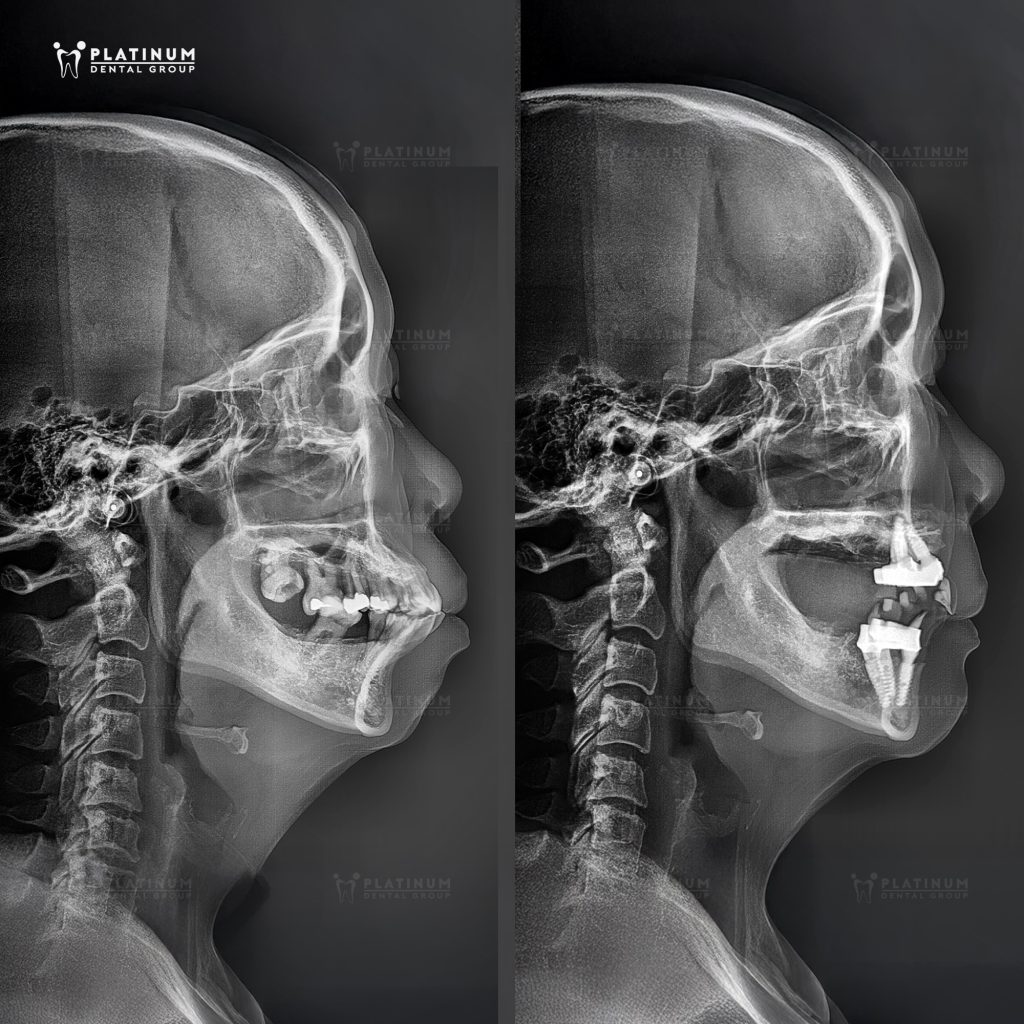 Hình phim thể hiện rất rõ tình trạng hô đã được cải thiện nhờ quá trình Implant được bác sĩ Tùng thực hiện.