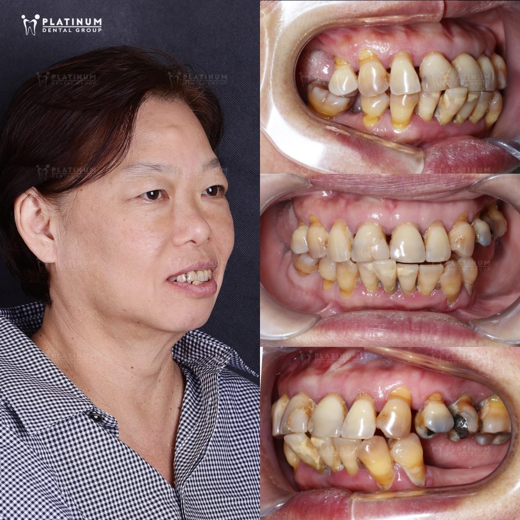 Tình trạng ban đầu của cô Vi Khanh, các răng hư hỏng nặng.