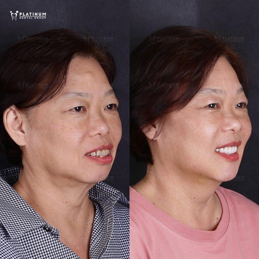 Góc nghiêng cô V.K đã thay đổi rất nhiều, gương mặt duyên dáng và thanh tú hơn.