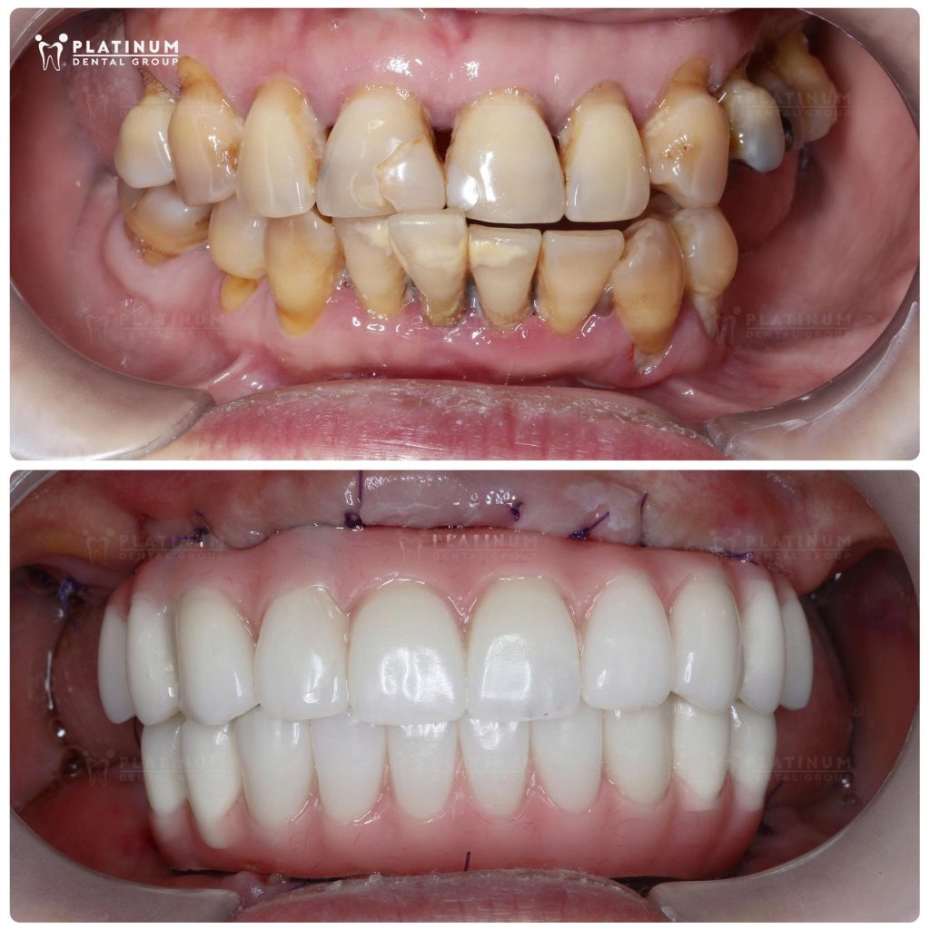 Platinum Dental có hàm tạm cố định cho cô chỉ sau 3 ngày cấy ghép, giúp cô ăn nhai trong 6 tháng chờ tích hợp hoàn toàn để làm phục hình sau cùng.