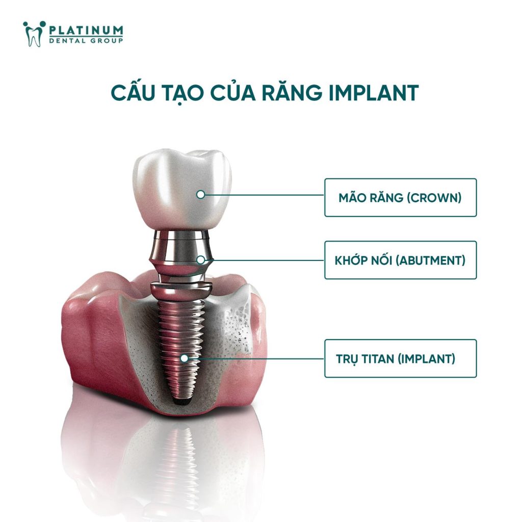 cau-tao-cua-rang-implant
