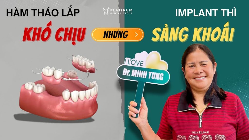 Có RĂNG TẠM NGAY SAU CẤY IMPLANT - "SẢNG KHOÁI" tức thì