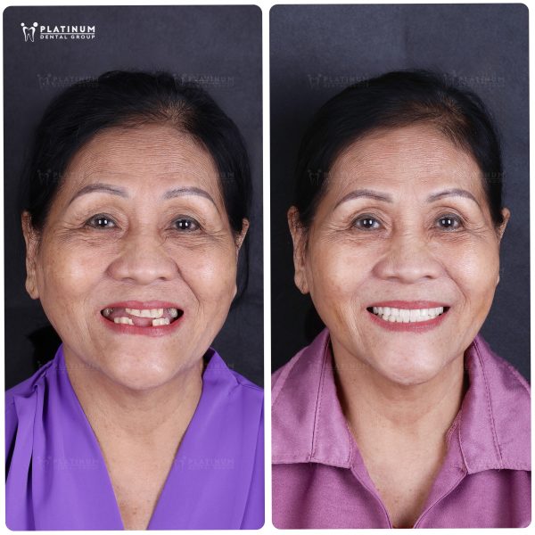 hinh anh kh implant 1