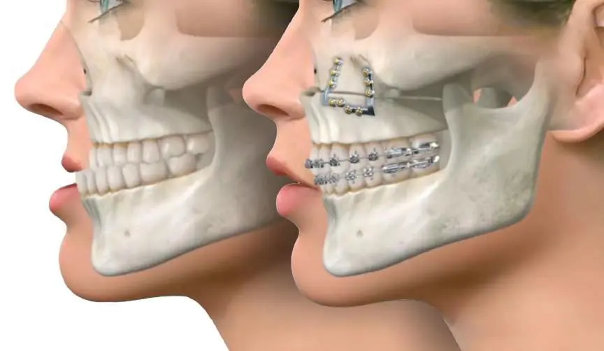 Jaw reconstruction surgery improves bite function, supports breathing and speech, and enhances facial balance