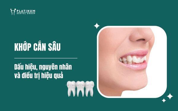 khớp cắn sâu