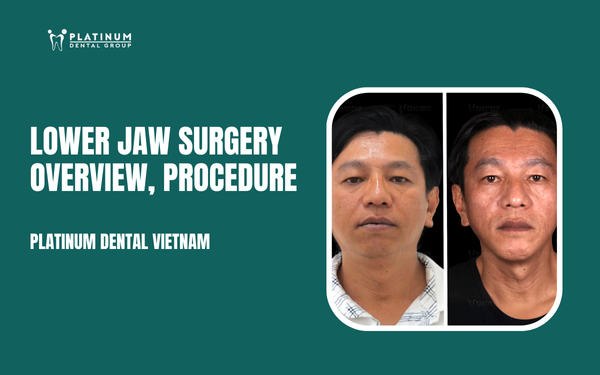 lower jaw surgery