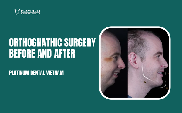 orthognathic surgery before and after