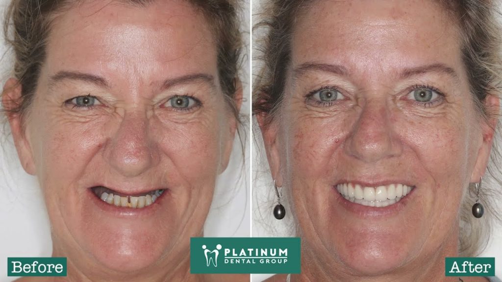 TÌM LẠI CẢM GIÁC ĂN NHAI TỰ NHIÊN VÀ NỤ CƯỜI TỰ TIN TẠI PLATINUM DENTAL