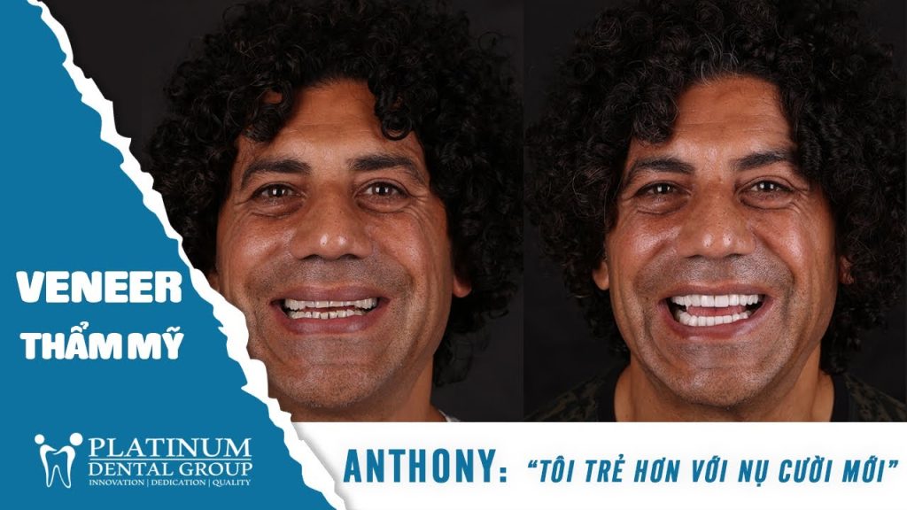 TÔI TRẺ HƠN VỚI NỤ CƯỜI MỚI REVIEW VENEER TỪ ANTHONY