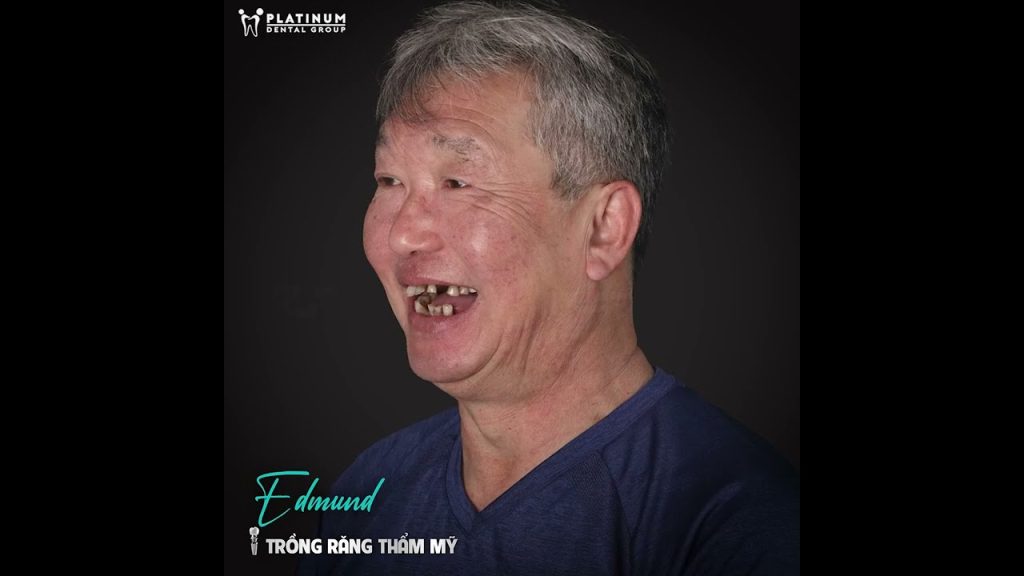 TRẢI NGHIỆM CẤY GHÉP IMPLANT CỦA MR. EDMUND TẠI PLATINUM DENTAL