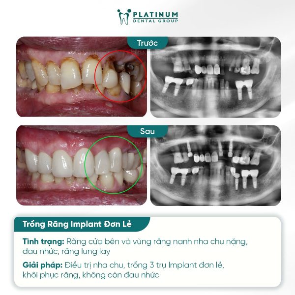 truong hop mat rang don le