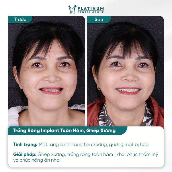 truong hop mat rang lau nam