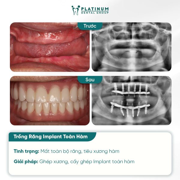 truong hop mat rang toan ham