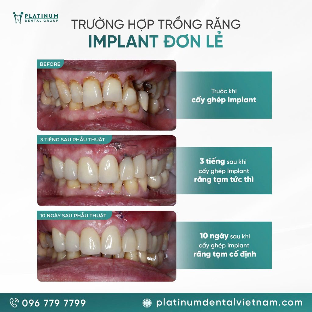 truong-hop-trong-rang-implant-don-le
