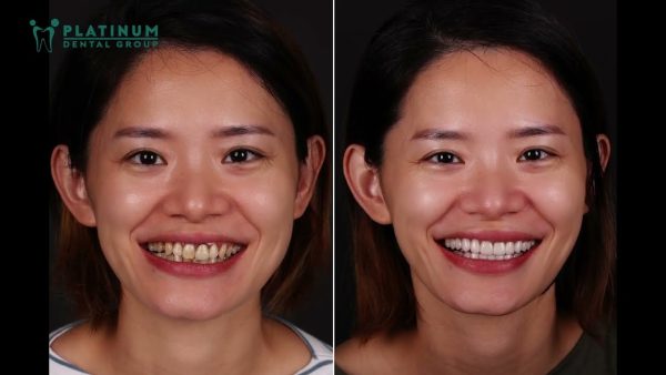 Becky Yuan Tôi yêu nụ cười của mình lúc này cảm ơn Platinum Dental đã giúp tôi tự tin trở lại