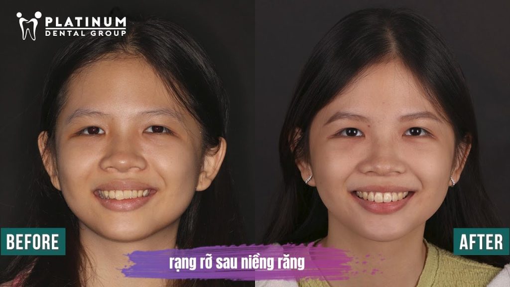 “Cười tự tin hơn vì răng đều và sáng hơn” – Huỳnh Lê Ngọc Minh