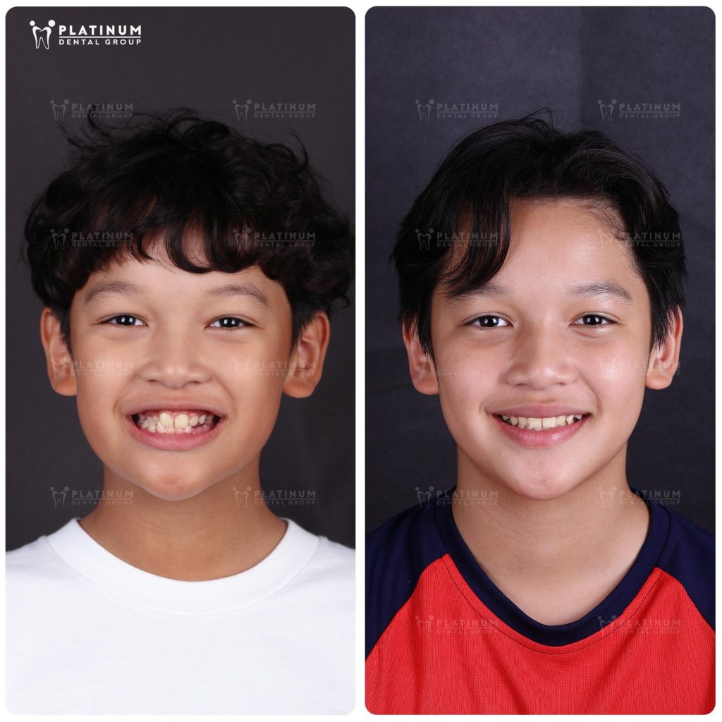 K.N came to Platinum Dental with a crossbite in the upper canine area, affecting both bite function and facial aesthetics.