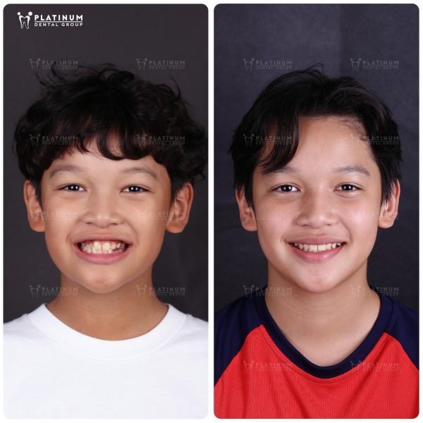 K.N came to Platinum Dental with a crossbite in the upper canine area, affecting both bite function and facial aesthetics.