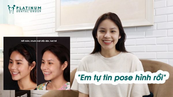 Hết móm, gương mặt hài hòa hơn sau 2 năm niềng răng mặt lưỡi Chia sẻ của Hoa Mai