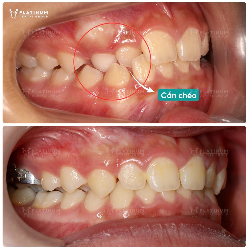 Sau 6 tháng sử dụng khí cụ nới rộng, vùng cắn chéo các răng bên hàm trên đã được đưa về vị trí đúng.