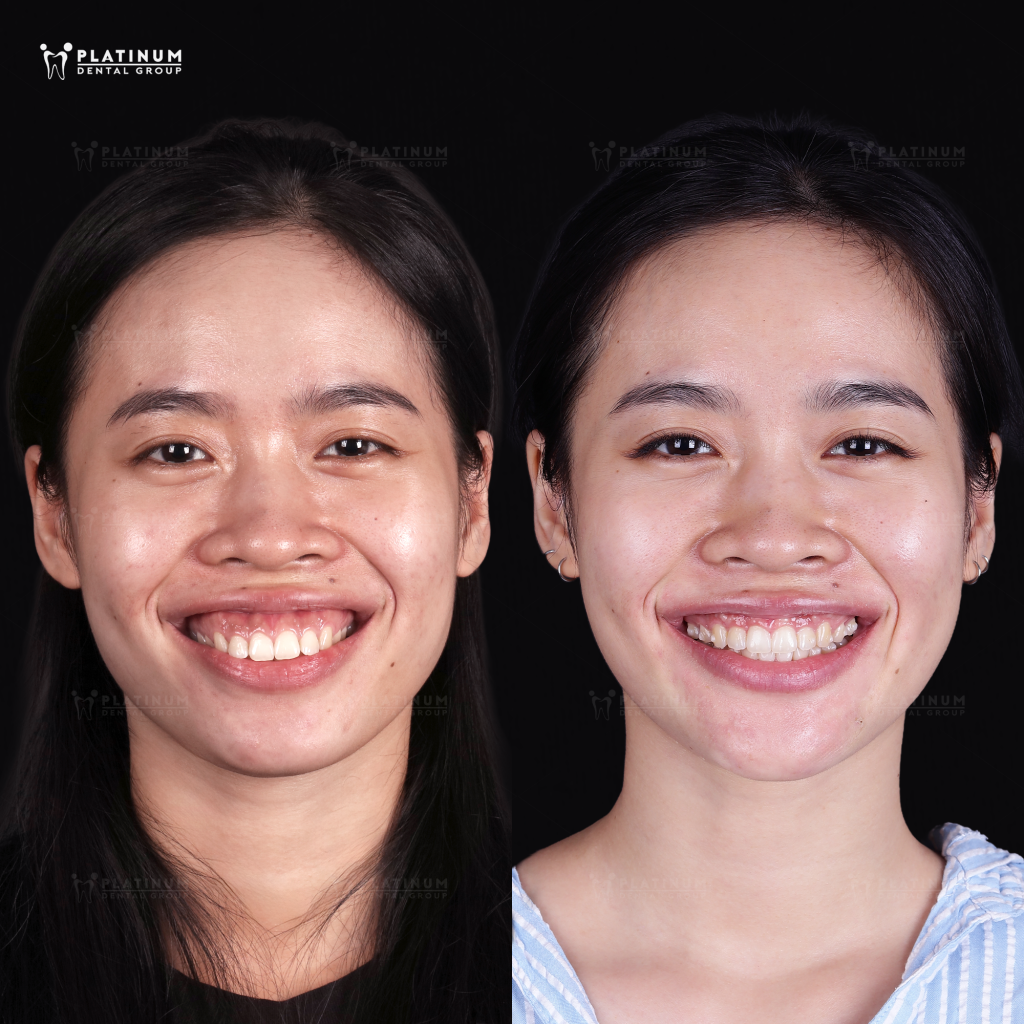 Cùng chiêm ngưỡng trước sự thay đổi nhờ niềng răng của Bích Phượng