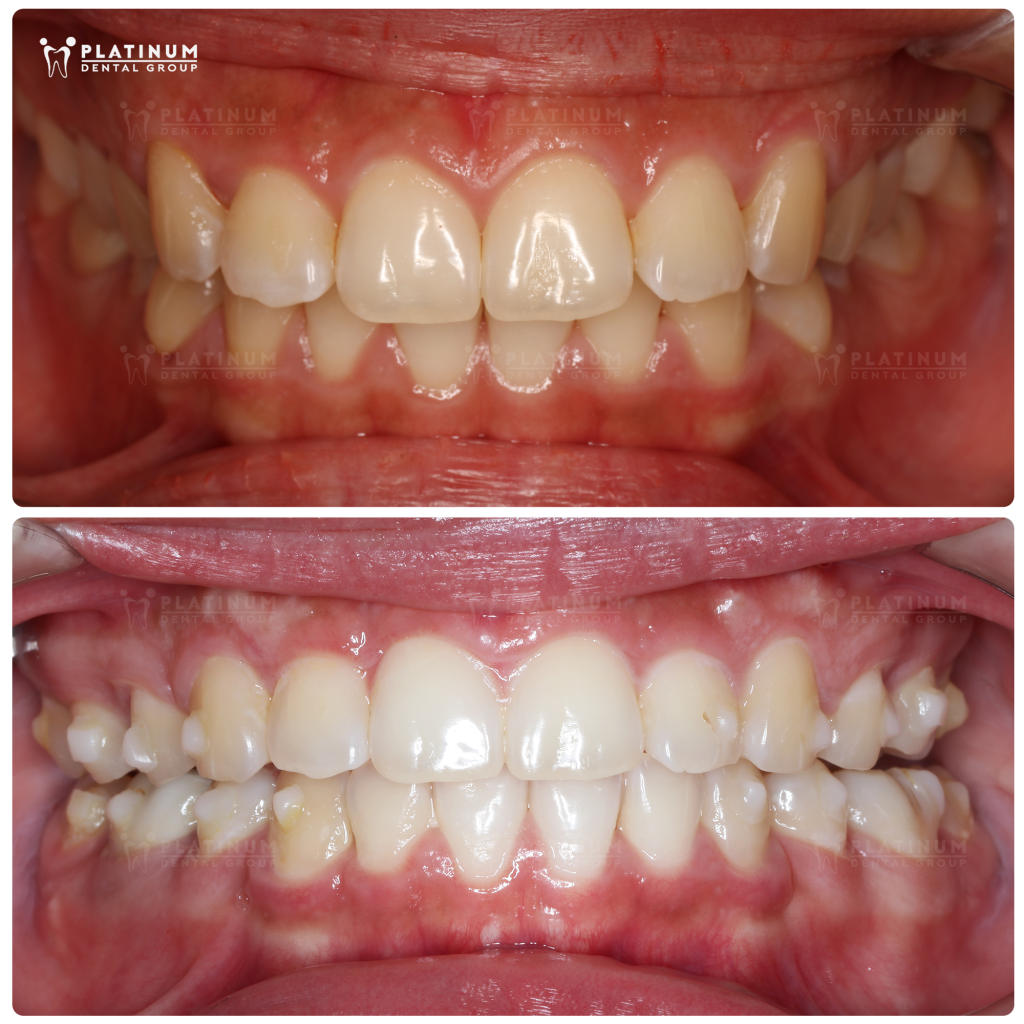 Niềng răng: Khắc phục hô và hở nướu không cần phẫu thuật