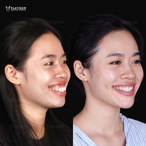 "Góc nghiêng nàng thơ" và sức mạnh của sự kiên trì