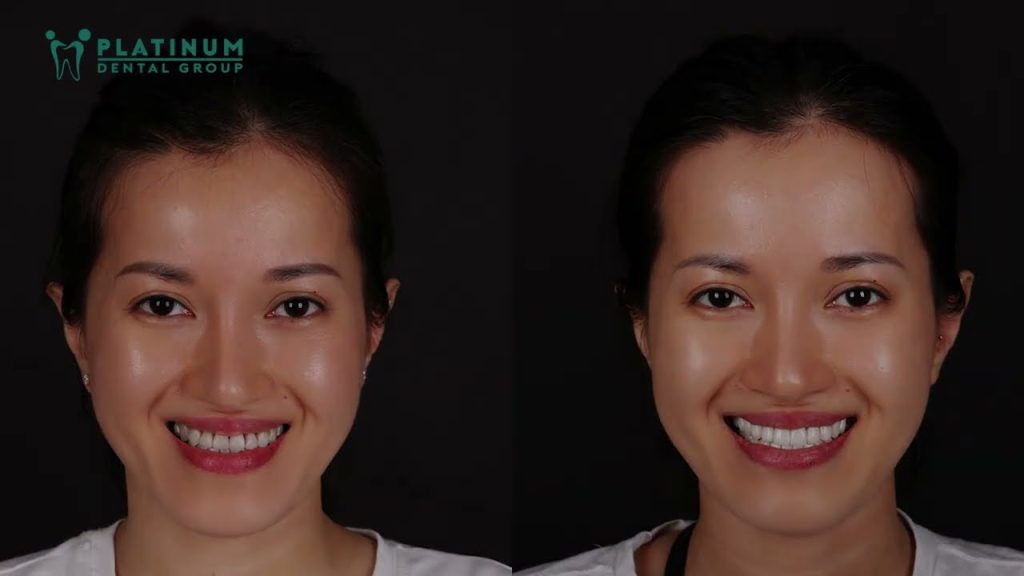 Niềng răng rồi nhưng vẫn chưa hài lòng và tôi đã quyết định làm lại Chị Mỹ Linh