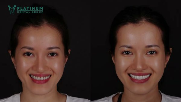 Niềng răng rồi nhưng vẫn chưa hài lòng và tôi đã quyết định làm lại Chị Mỹ Linh