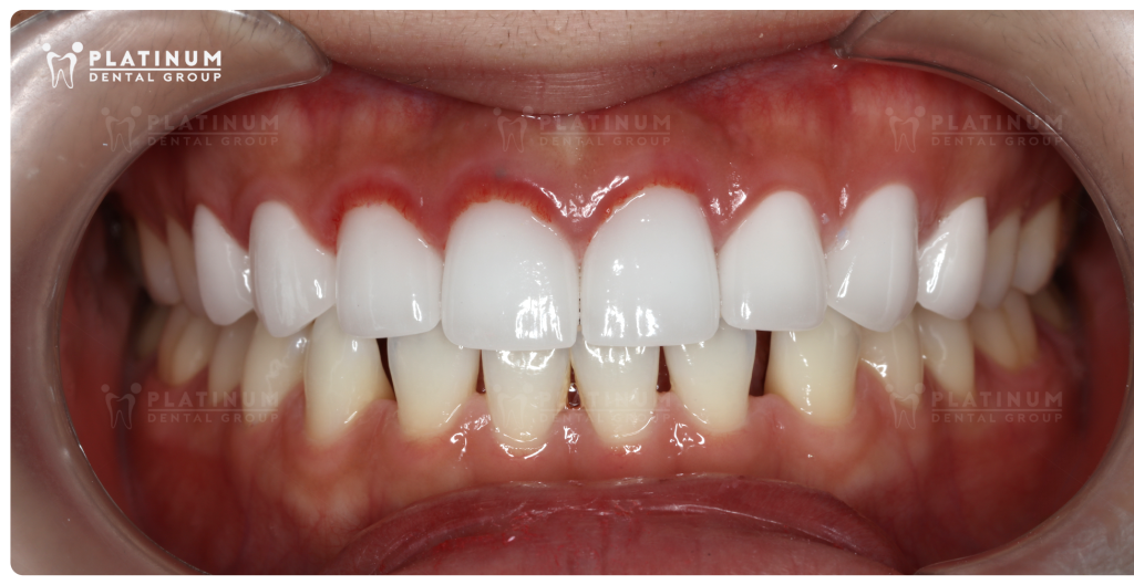 Tình trạng ban đầu với hàm trên đã thực hiện bọc sứ nhưng bị viêm nướu sưng đỏ