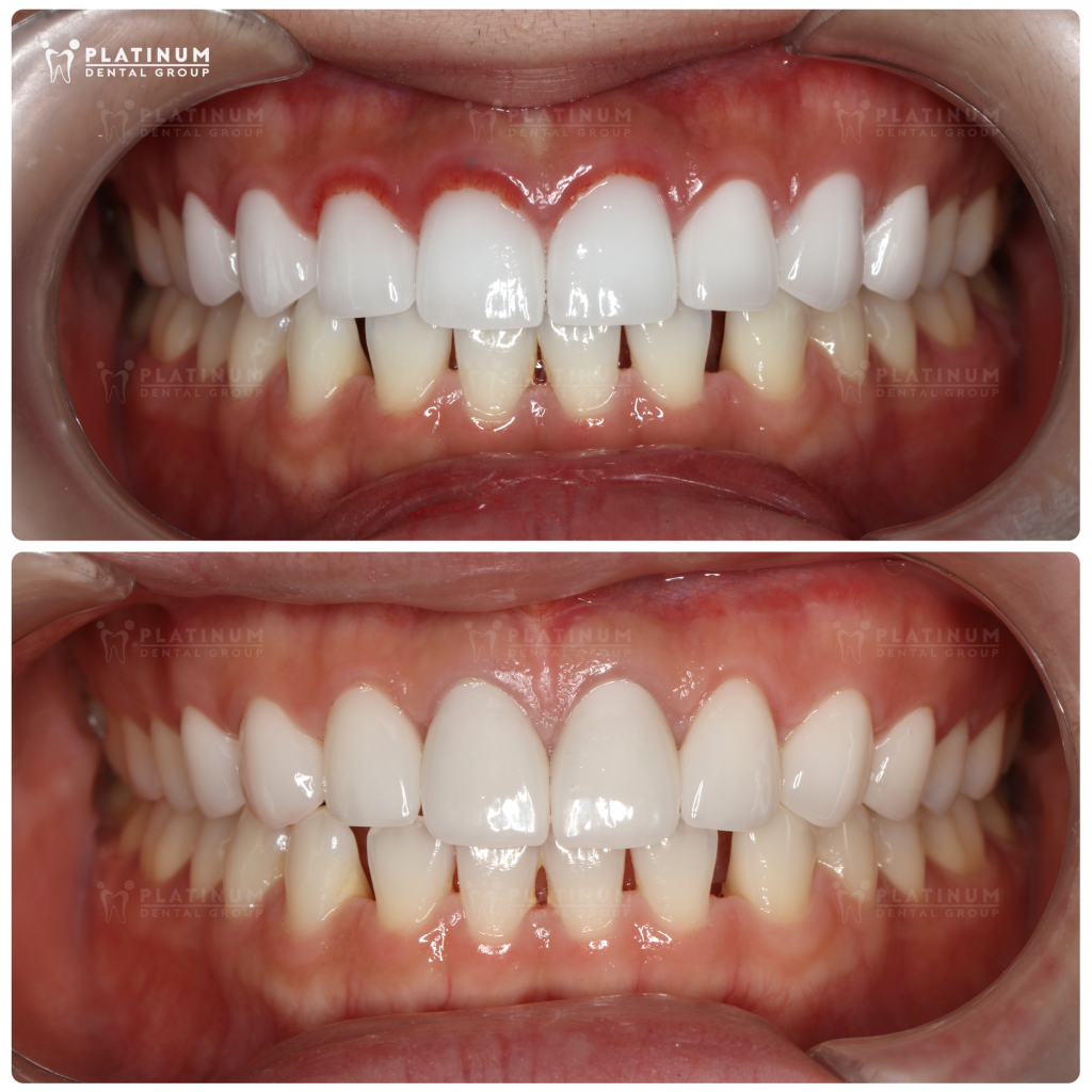 A careful step-by-step recovery plan