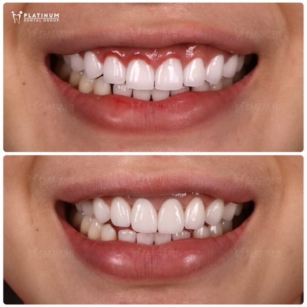 P.T’s restoration required time, precision, and patience