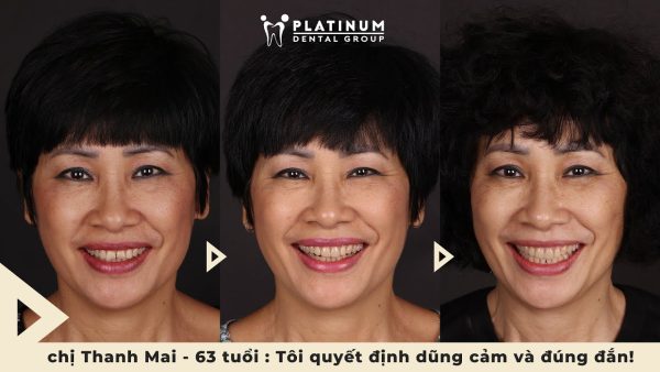 “Tôi đã đủ dũng cảm để thay đổi nụ cười của mình” – Chị Thanh Mai