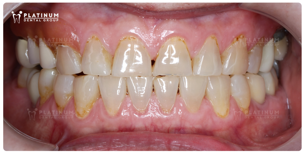 Vấn đề ban đầu chị Tâm gặp phải là tình trạng các răng mòn mặt nhai, răng ố màu.