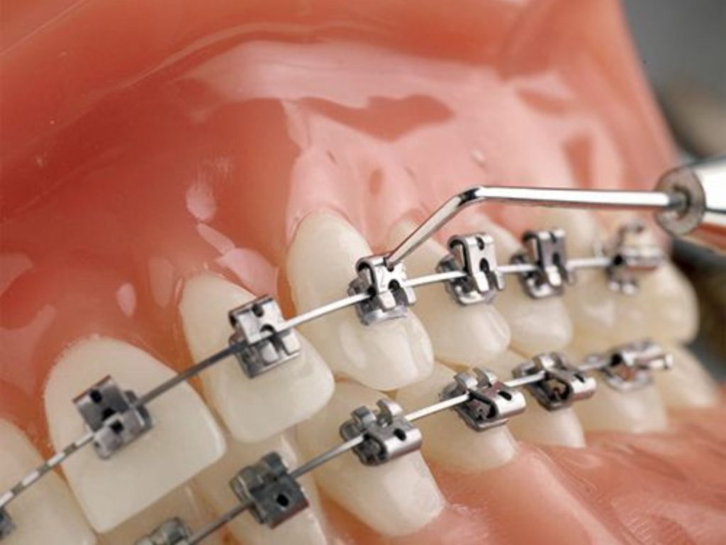 Vít niềng răng là một vít kim loại sinh học có kích thước nhỏ