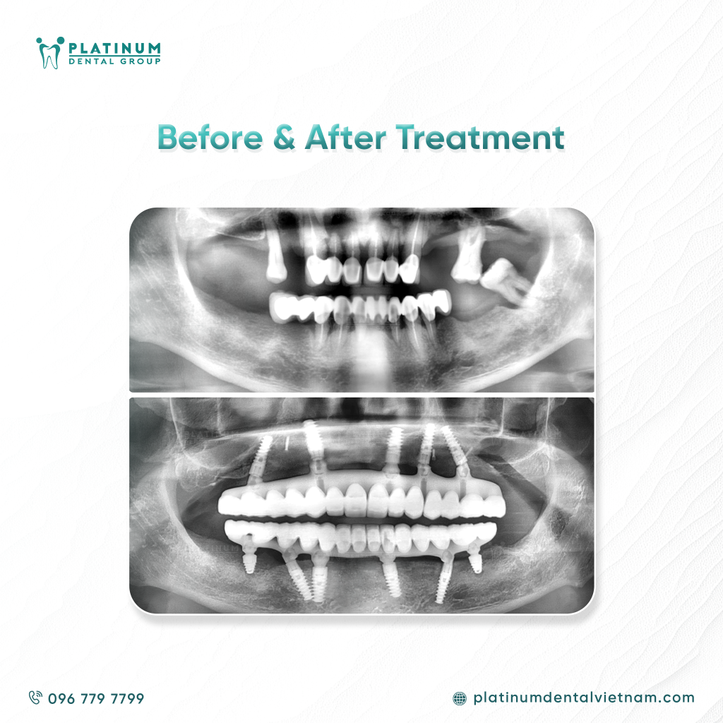 One year later, once the implants had perfectly integrated with the jawbone as planned, Mr. L.V. returned to Vietnam for the final step: The Permanent Fixed Restoration.