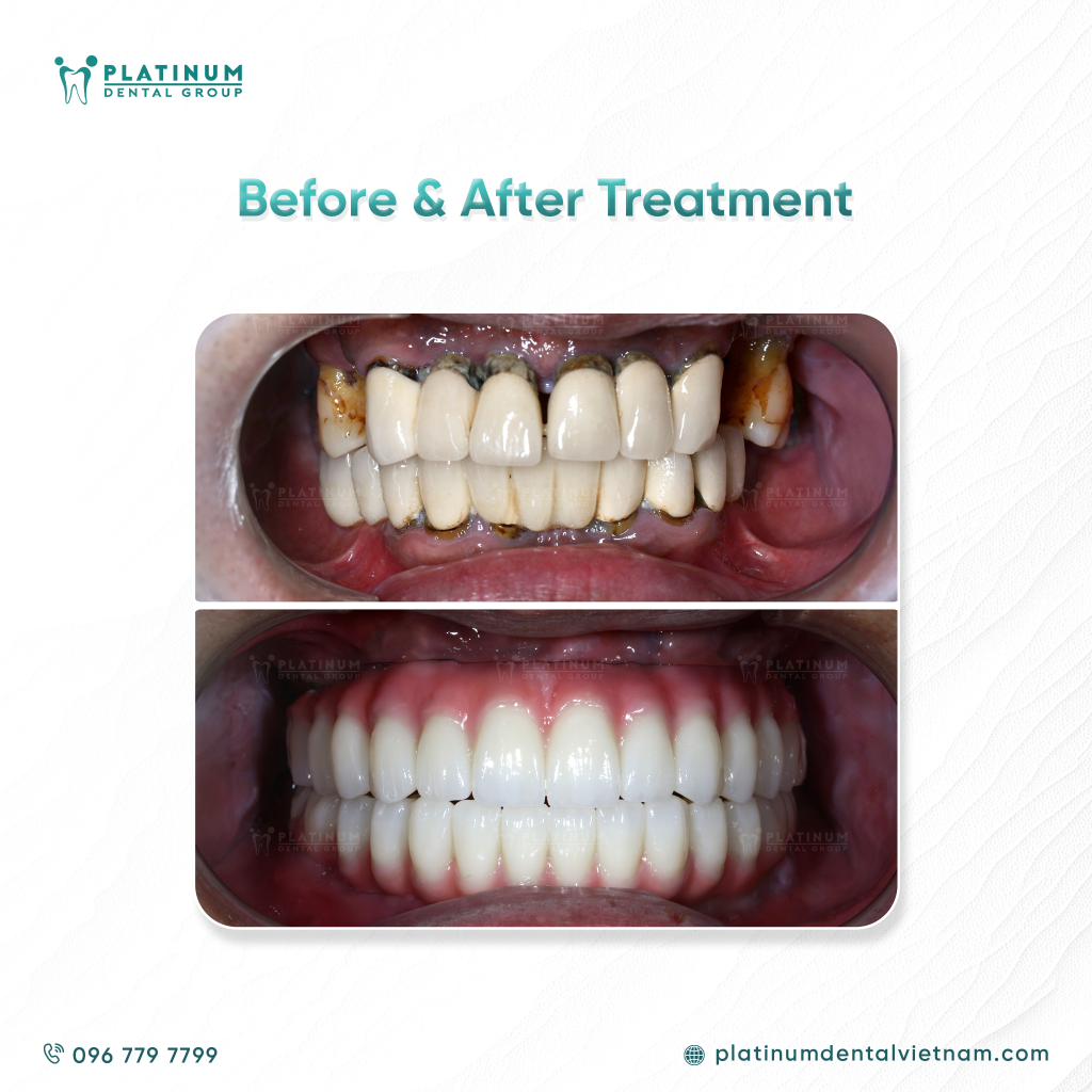 Clinical results showed the implants were exceptionally stable with no complications