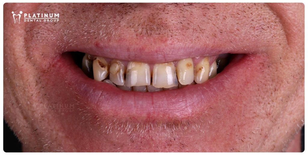 After taking the time to carefully research his options, Mr. Jeffrey chose Platinum Dental for a comprehensive treatment plan.