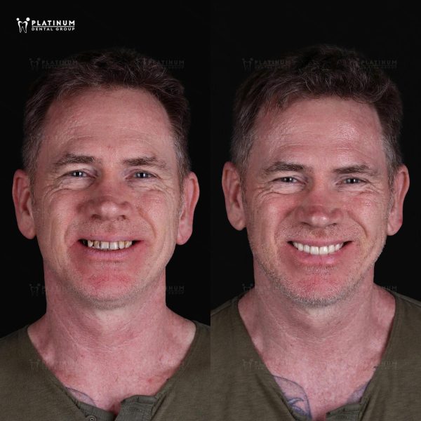 seeing his new smile in the mirror