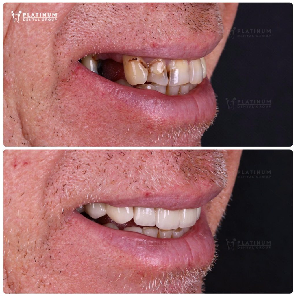 Toàn bộ quá trình được lên kế hoạch chặt chẽ ngay từ đầu, đảm bảo sự tương trợ giữa Implant và phục hình sứ, từ đó giúp tái lập khớp cắn ở trạng thái ổn định, thoải mái và bền vững lâu dài.