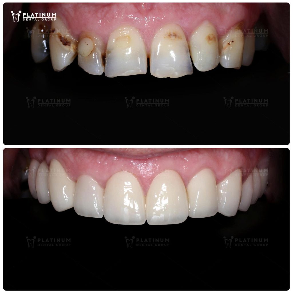 Sự thay đổi sau điều trị phục hình sứ hàm trên