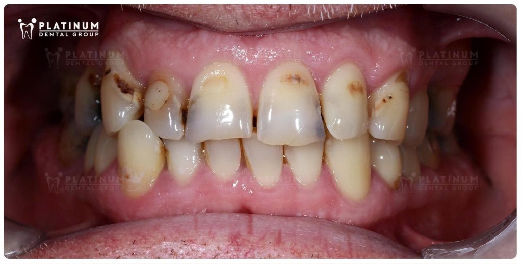 Mr. Jeffrey đến Platinum Dental với tình trạng hàm răng gặp nhiều vấn đề